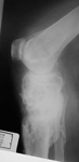 Boyd, Follow up thumbnail of an x-ray, Limb Lengthening, deformity corrected, alignment, pain-free, arthritis progression slowed