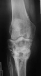 Boyd, Follow up thumbnail of an x-ray, Limb Lengthening, deformity corrected, alignment, pain-free, arthritis progression slowed
