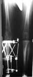 Boyd, Post-op thumbnail of an x-ray, Limb Lengthening, percutaneous osteotomy, ilizarov/ taylor spatial frame, deformity correction, correction of genu varum