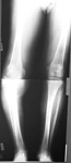 Boyd, Pre-op thumnbail of an x-ray, Limb Lengthening, tibia fracture infection, deformity, genu varum, bowleg