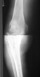 Boyd, Pre-op thumnbail of an x-ray, Limb Lengthening, tibia fracture infection, deformity, genu varum, bowleg