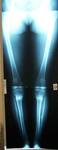 Brenda, Follow up thumbnail of an x-ray, Limb Lengthening, deformity corrected