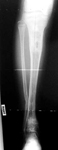 James, Follow up thumbnail of an x-ray, limb lengthening, equal leg lengths, deformity corrected