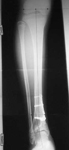 James, Pre-op thumbnail of an x-ray, limb lengthening, injured growth plate, external rotation, varus deformity