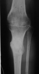 daniel, follow up thumbnail of an x-ray, limb lengthening, knee arthrodesis, lengthening, deformity corrected