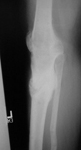 daniel, follow up thumbnail of an x-ray, limb lengthening, knee arthrodesis, lengthening, deformity corrected
