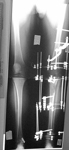 daniel, post-op thumbnail of an x-ray, limb lengthening, cleaned infection, arthrodesis of the knee, lengthened tibia, ilizarov frame