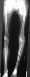 daniel, pre-op thumbnail of an x-ray, limb lengthening, open knee fracture, infection, deformity, osteomyelitis, septic arthritis