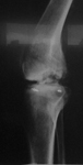 daniel, pre-op thumbnail of an x-ray, limb lengthening, open knee fracture, infection, deformity, osteomyelitis, septic arthritis