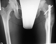 Philip, Follow up thumbnail of an x-ray, Limb Lengthening, deformity corrected, leg lengthened