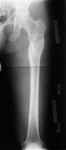 Philip, Follow up thumbnail of an x-ray, Limb Lengthening, deformity corrected, leg lengthened