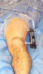 Philip, Post-op Image, Limb Lengthening, acute correction, percutaneously, monolateral frame, intrameduallary rod