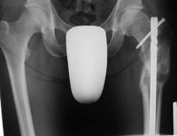 Philip, Post-op thumbnail of an x-ray, Limb Lengthening, acute correction, percutaneously, monolateral frame, intrameduallary rod