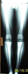 Marquis, Follow up thumbnail of an x-ray, Limb Lengthening, Bilateral Genu Varum corrected, bowlegged alignment, minimally invasive techinque