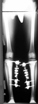 Marquis, Post-op thumbnail of an x-ray, Limb Lengthening, Bilateral Genu Varum, bowlegged alignment, bilateral tibial osteotomies