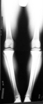 Marquis, Pre-op thumbnail x-ray, Limb Lengthening, Bilateral Genu Varum, bowlegged alignment, knee pain