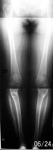 Yesinia, Follow up thumbnail of an x-ray, Limb Lengthening, Arthritis prevention, Knock-knee deformity treated, no knee pain