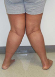 Yesinia, Pre-op thumbnail Image, Limb Lengthening, Genu Valgum, Knock-knee deformity