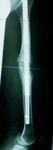 Herbert, Follow up thumbnail of an x-ray, Limb Lengthening, Internal Lengthening Nail, ISKD rod, full knee and hip mobility