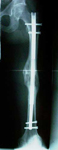 Herbert, Follow up thumbnail of an x-ray, Limb Lengthening, Internal Lengthening Nail, ISKD rod, full knee and hip mobility