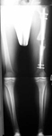 Herbert, Post-op thumbnail of an x-ray, Limb Lengthening, Internal Lengthening Nail, femur fracture, osteotomy, ISKD rod