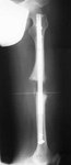 Herbert, Post-op thumbnail of an x-ray, Limb Lengthening, Internal Lengthening Nail, femur fracture, osteotomy, ISKD rod