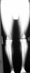 Herbert, Pre-op thumbnail of an x-ray, Limb Lengthening, Internal Lengthening Nail, femur fracture, hyperextension