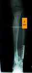 Nicholas, Follow up thumbnail of an X-ray, Limb Lengthening, Bone Transport, Tibia, Bone healed, avoid amputation