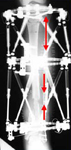 Nicholas, Post-Op thumbnail of an X-ray, Limb Lengthening, Bone Transport, Tibia