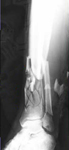 Nicholas, Pre-Op thumbnail of an X-ray, Limb Lengthening, Limb Salvage, Bone Transport, Tibia