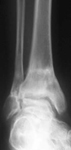 Claudia, Follow up thumbnail of an x-ray, Limb Lengthening, minimal pain, arthritis prevention