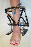 Claudia, Post-op thumbnail image, Limb Lengthening, Ankle Distraction, distal tibia and fibula osteotomy