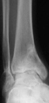 Claudia, Pre-op thumbnail of an x-ray, Limb Lengthening, Ankle Distraction, post-traumatic arthritis, varus deformity