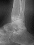Ayaka, Follow up thumbnail of an X-ray, Limb Lengthening, improved ankle joint space, talus improvement