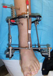 Ayaka, Post-op thumbnail Image, Limb Lengthening, Ankle Distraction, Arthritis, ankle distraction