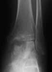 Ayaka, Post-op thumbnail of an x-ray, Limb Lengthening, osteopenia, revascularization of the talus, absence of collapse