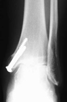 Ayaka, Pre-op thumbnail of an x-ray, Limb Lengthening, Ankle Distraction, Arthritis, Avascular necrosis of the talus