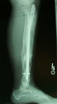 Marcelle, Follow up thumbnail of an x-ray, Limb Lengthening, tibia healed, Bone Transport 