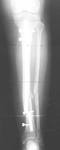 Marcelle, Pre-op thumbnail of an X-ray, Limb Lengthening, infected tibia nonunion