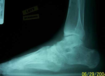 Dale, Follow up thumbnail of an x-ray, Limb Lengthening, Correction of Clubfoot, plantigrade