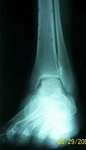 Dale, Follow up thumbnail of an x-ray, Limb Lengthening, Correction of Clubfoot, plantigrade