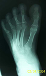 Dale, Pre-op thumbnail of an x-ray, Limb Lengthening, Clubfoot, complex foot deformity