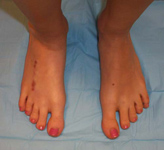 Alyssa, Follow up thumbnail image, limb lengthening, Metatarsal Lengthening, foot deformity corrected
