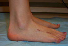 Alyssa, Follow up thumbnail image, limb lengthening, Metatarsal Lengthening, foot deformity corrected