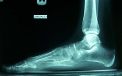 Alyssa, Follow up thumbnail of an X-ray, limb lengthening, Metatarsal Lengthening, foot deformity corrected