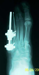 Alyssa, Post-op thumbnail of an x-ray, limb lengthening, osteotomy, MTP Joint, Metatarsal Lengthening, foot deformity