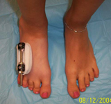 Alyssa, Post-op thumbnail image, limb lengthening, osteotomy, MTP Joint, Metatarsal Lengthening, foot deformity