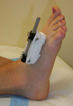 Alyssa, Post-op thumbnail image, limb lengthening, osteotomy, MTP Joint, Metatarsal Lengthening, foot deformity