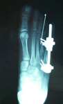 Alyssa, Post-op thumbnail of an x-ray, limb lengthening, osteotomy, MTP Joint, Metatarsal Lengthening, foot deformity