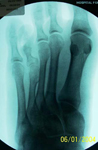 Alyssa, Pre-op thumbnail of an x-ray, limb lengthening, Metatarsal Lengthening, foot deformity